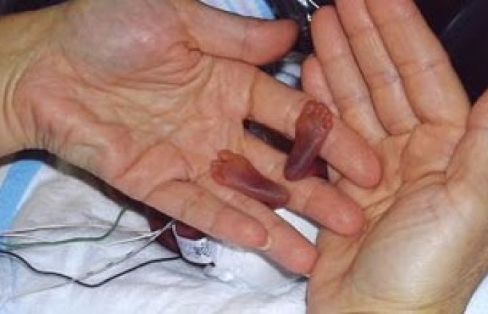 Самый маленький новорожденный ребёнок. (3 фото)