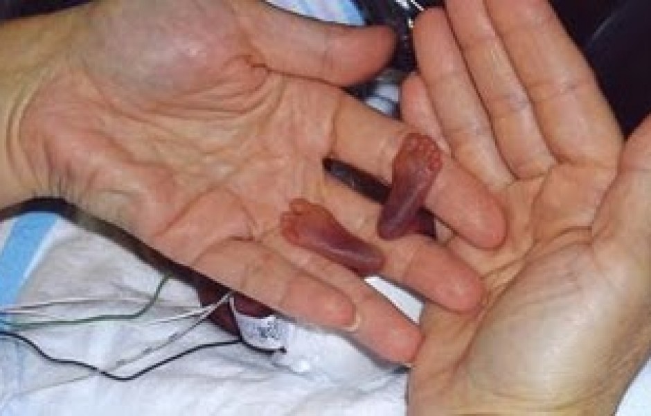 Самый маленький новорожденный ребёнок. (3 фото)