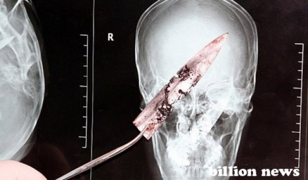 Самые интересные факты: человек прожил 4 года с ножом в черепе