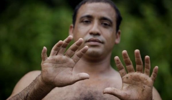 Человек с 24 пальцами (5 фото)