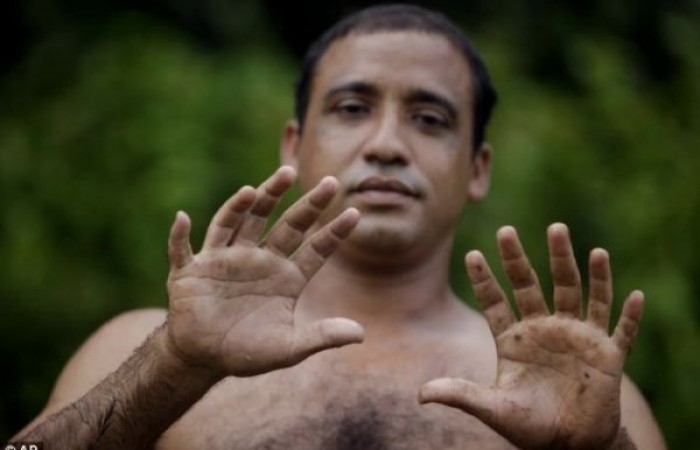 Человек с 24 пальцами (5 фото)