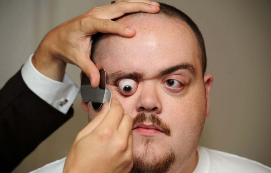 Человек с самыми выпирающими глазами в мире (4 фото + видео)