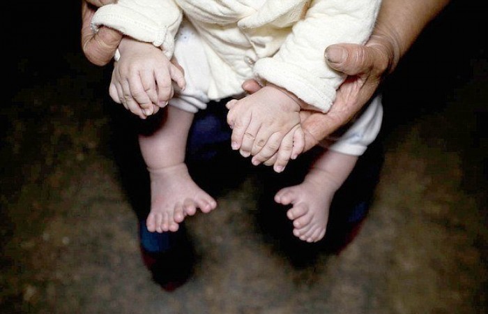 В Китае родился мальчик у которого 31 палец (5 фото)