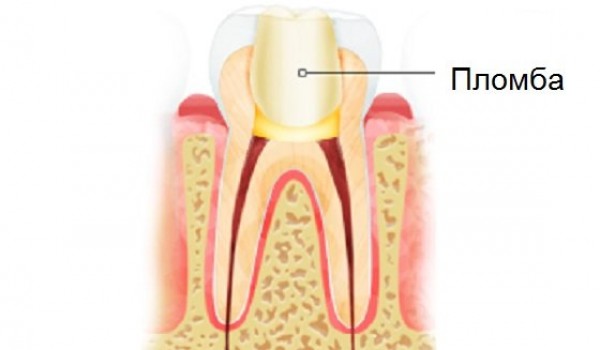 Какие зубные пломбы бывают в стоматологиях Воронежа и других городов