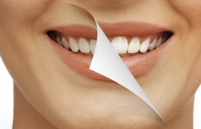 Несколько мифов зубной имплантации и их разоблачение