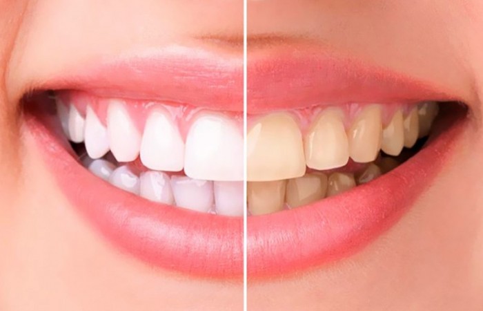 Безопасное и быстрое отбеливание зубов с помощью ZOOM 4
