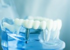 Факты об имплантации зубов