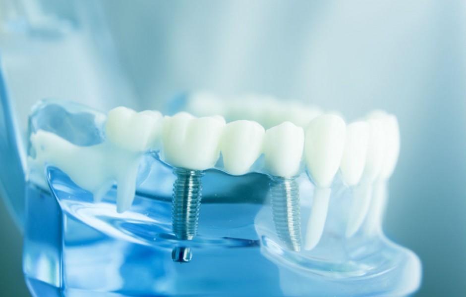 Факты об имплантации зубов