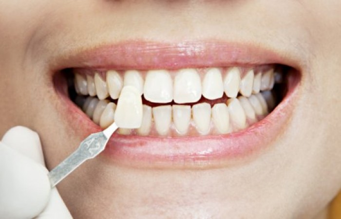 6 интересных фактов о стоматологических винирах