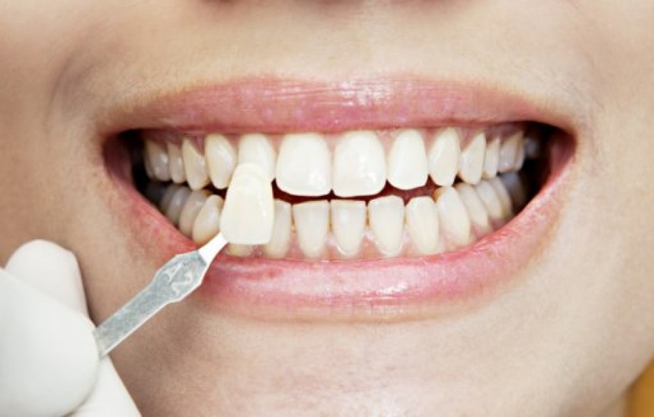 6 интересных фактов о стоматологических винирах
