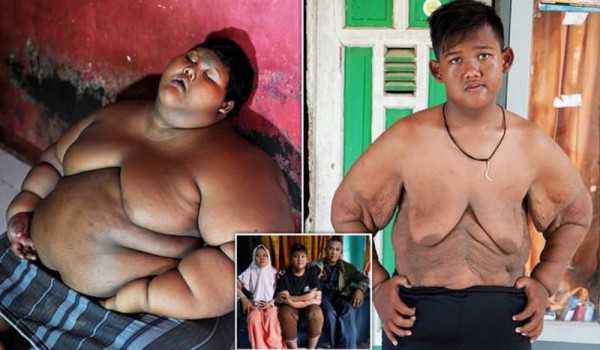 Самый толстый мальчик в мире, который весил 192 кг в 10-летнем возрасте, похудел больше, чем вдвое...