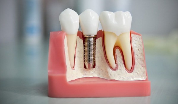 Интересные факты об имплантации зубов