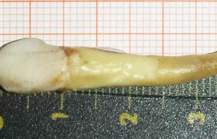 У человека удален самый длинный зуб в истории