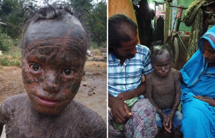 В Индии живет мальчик со змеиной кожей (7 фото)