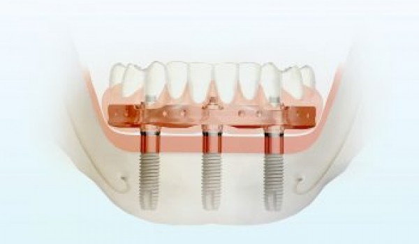 Одномоментная имплантация зубов – особенности