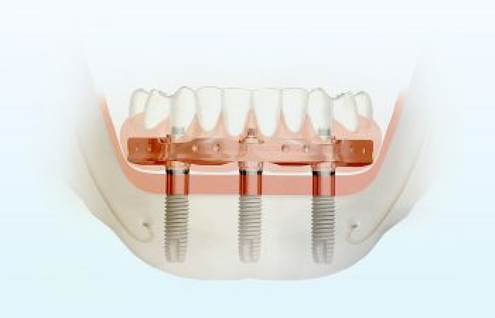 Одномоментная имплантация зубов – особенности