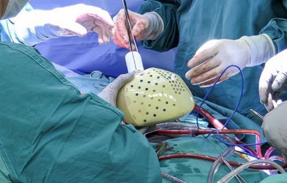 В США впервые в истории имплантировали человеку полностью искусственное сердце (5 фото)
