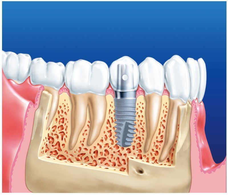 Интересные факты об имплантации зубов