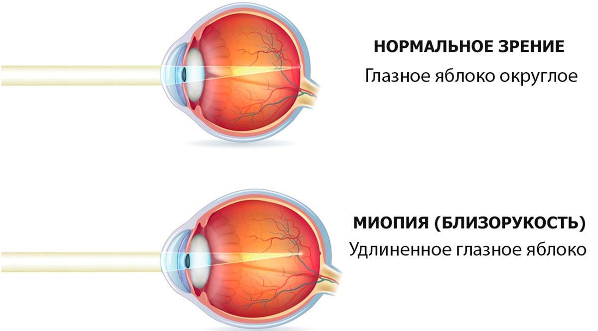 Картинки при миопии